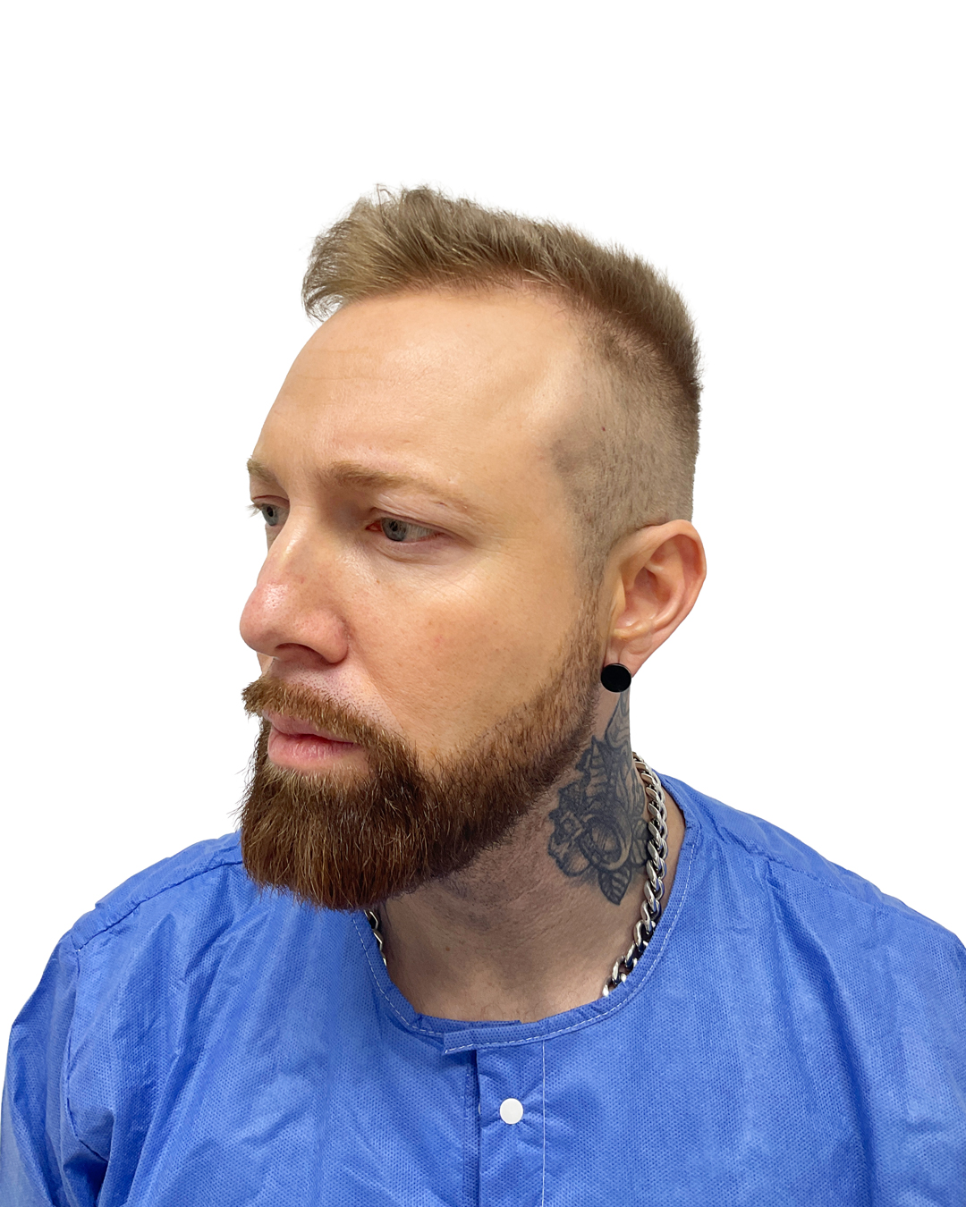 Benjamin før hårtransplantationen