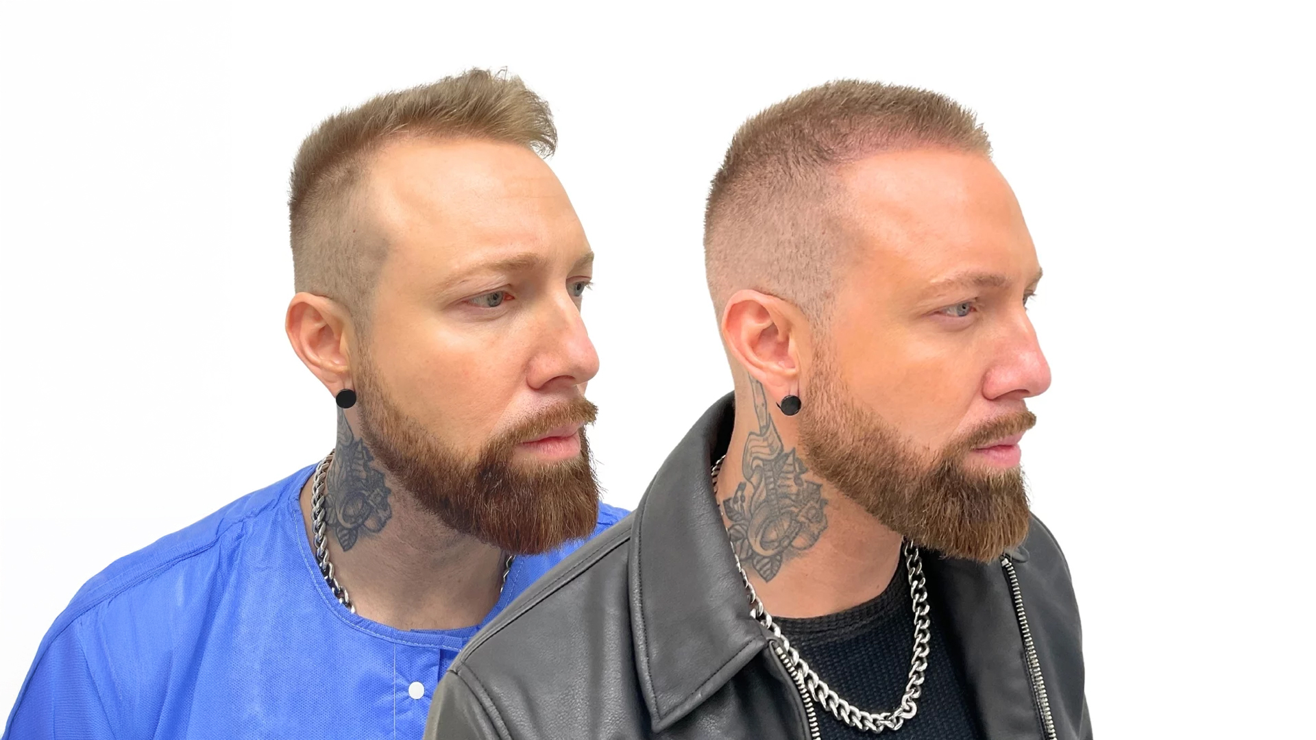 Benjamin – før og efter sin hårtransplantation