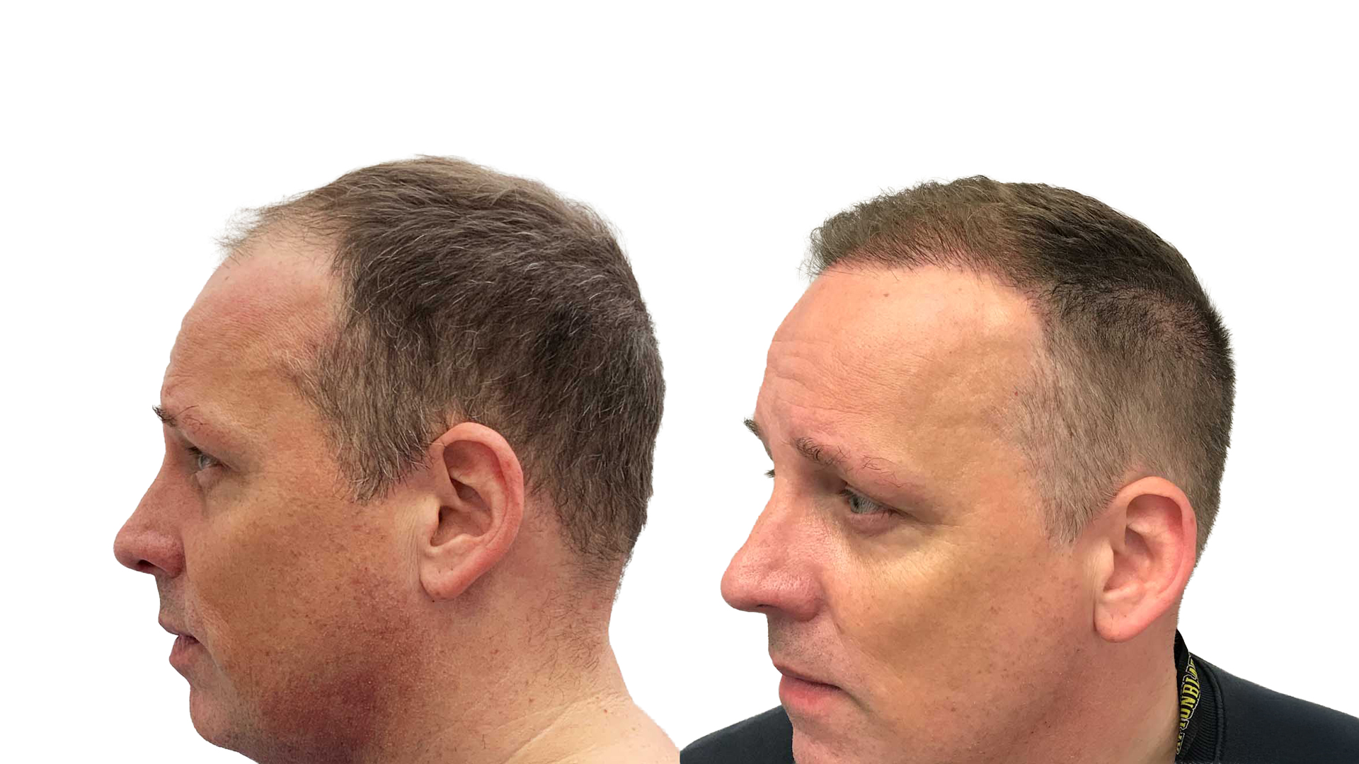 Benjamin – før og efter sin hårtransplantation