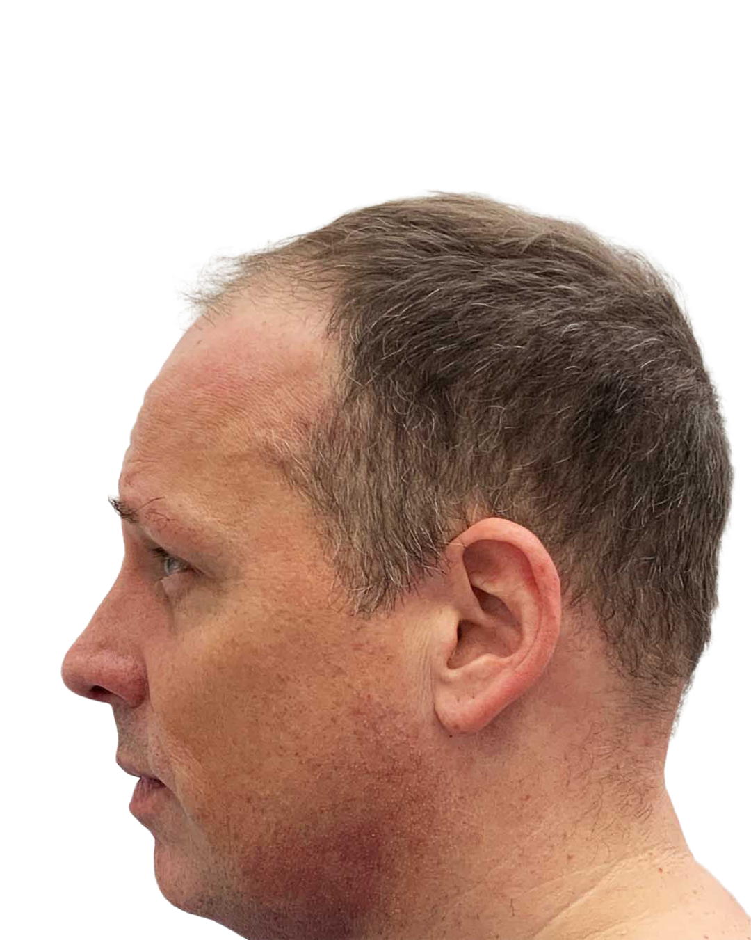 Benjamin før hårtransplantationen