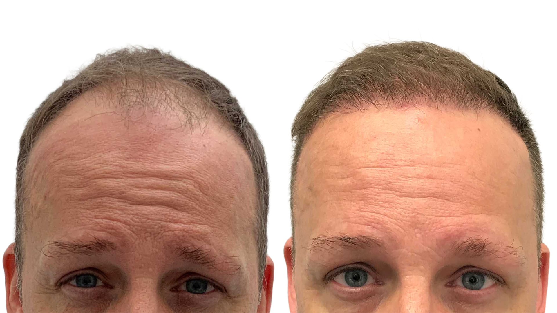 Benjamin – før og efter sin hårtransplantation