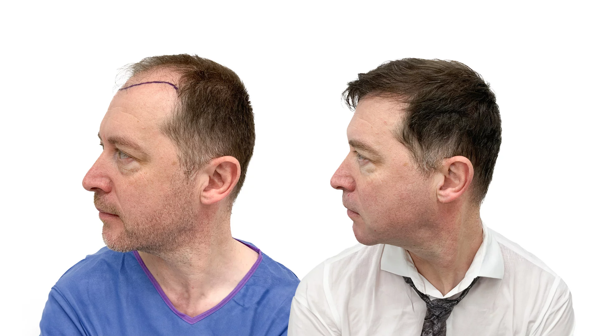 Brian – før og efter sin hårtransplantation