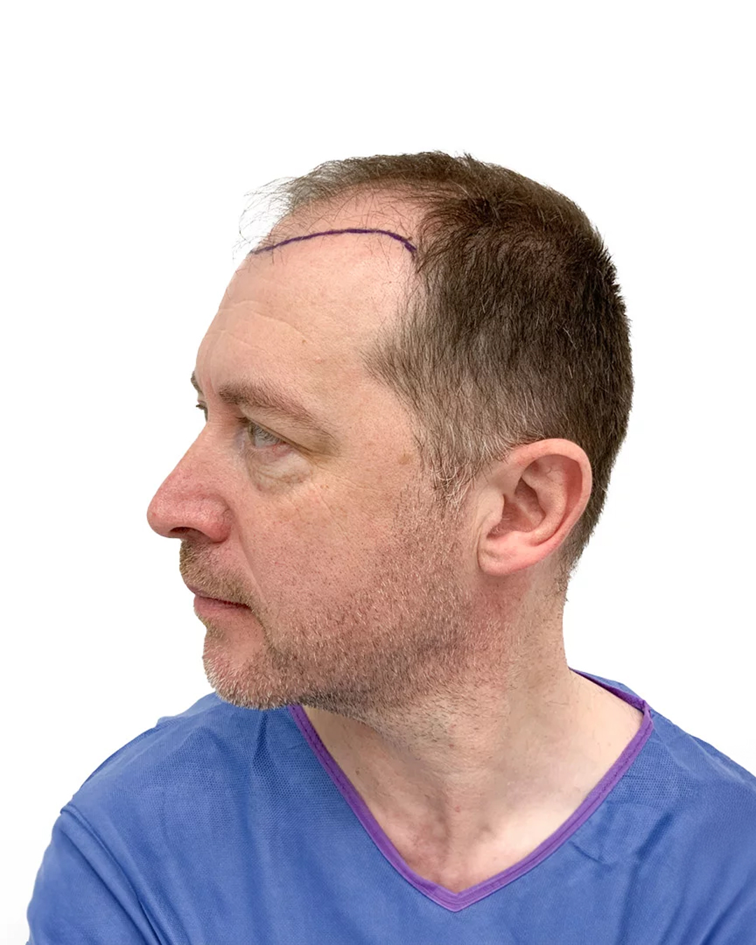 Brian før hårtransplantationen