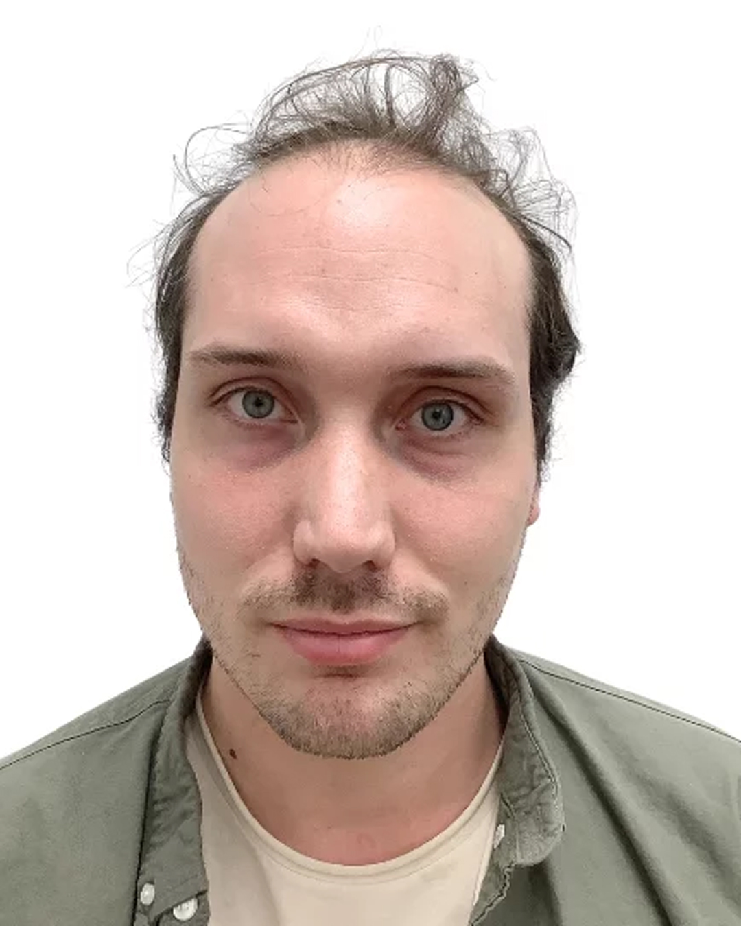 Buster før hårtransplantationen