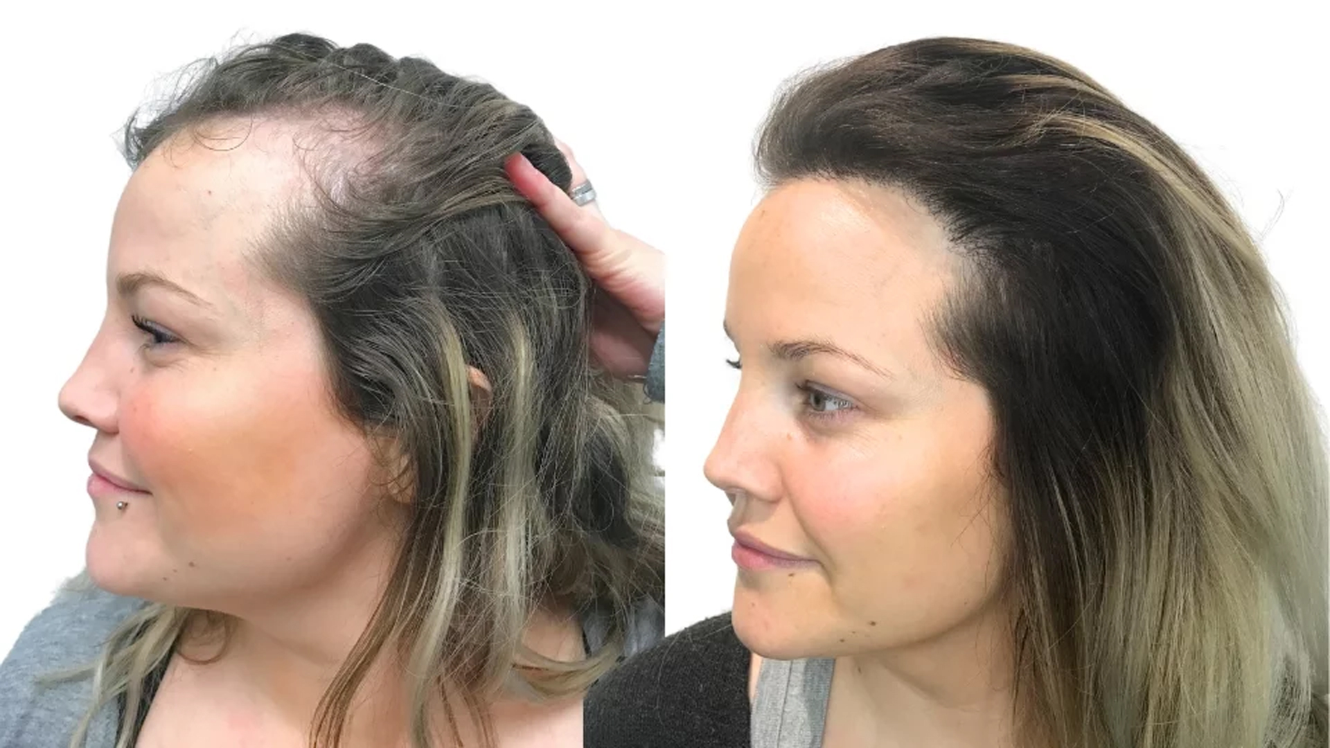 Camilla – før og efter sin hårtransplantation