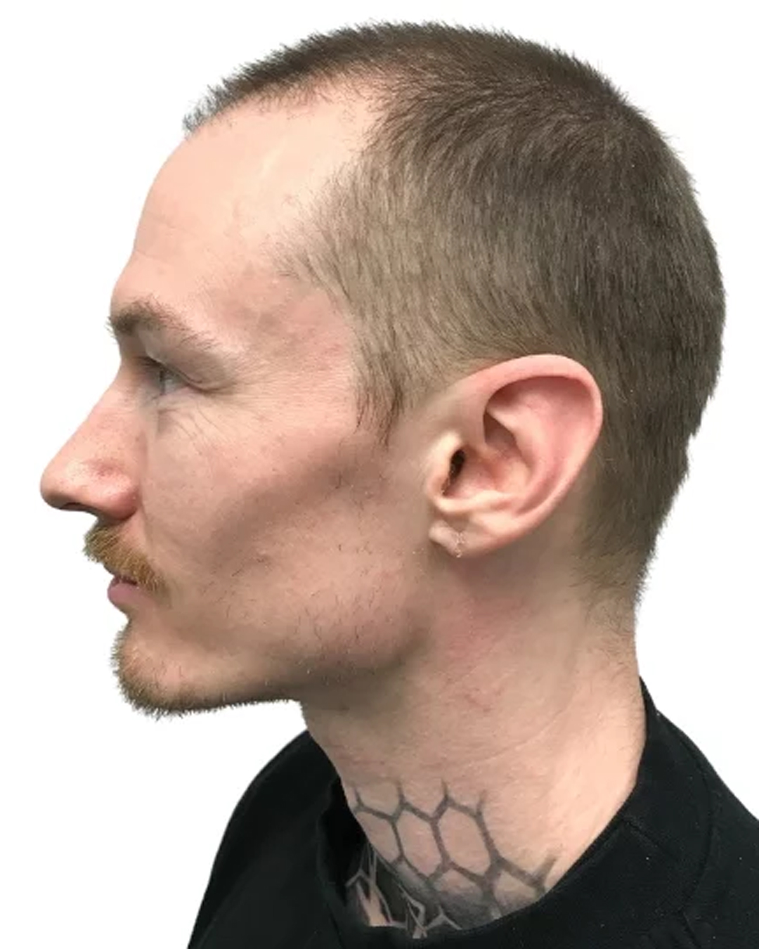 Carl før skægtransplantationen