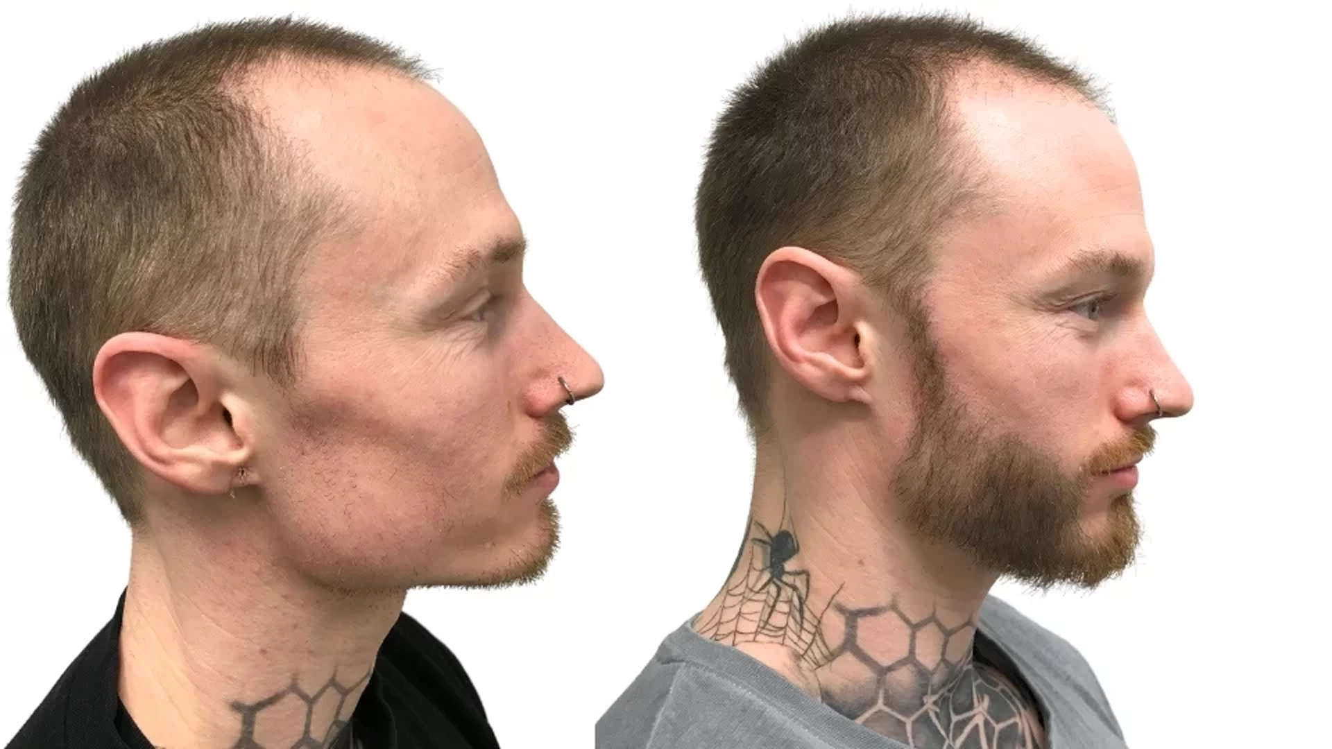 Carl – før og efter sin skægtransplantation