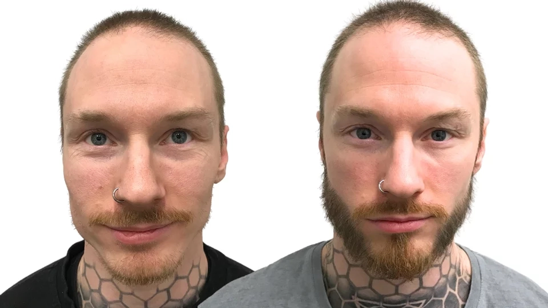 Carl – før og efter sin skægtransplantation