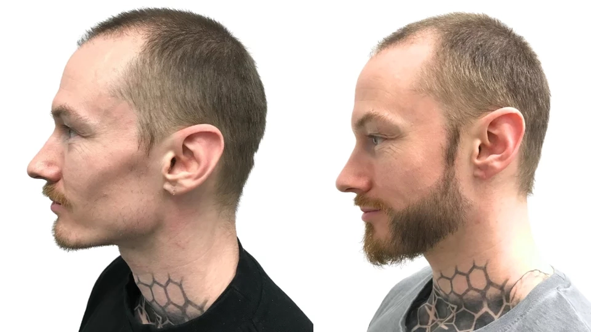 Carl – før og efter sin skægtransplantation