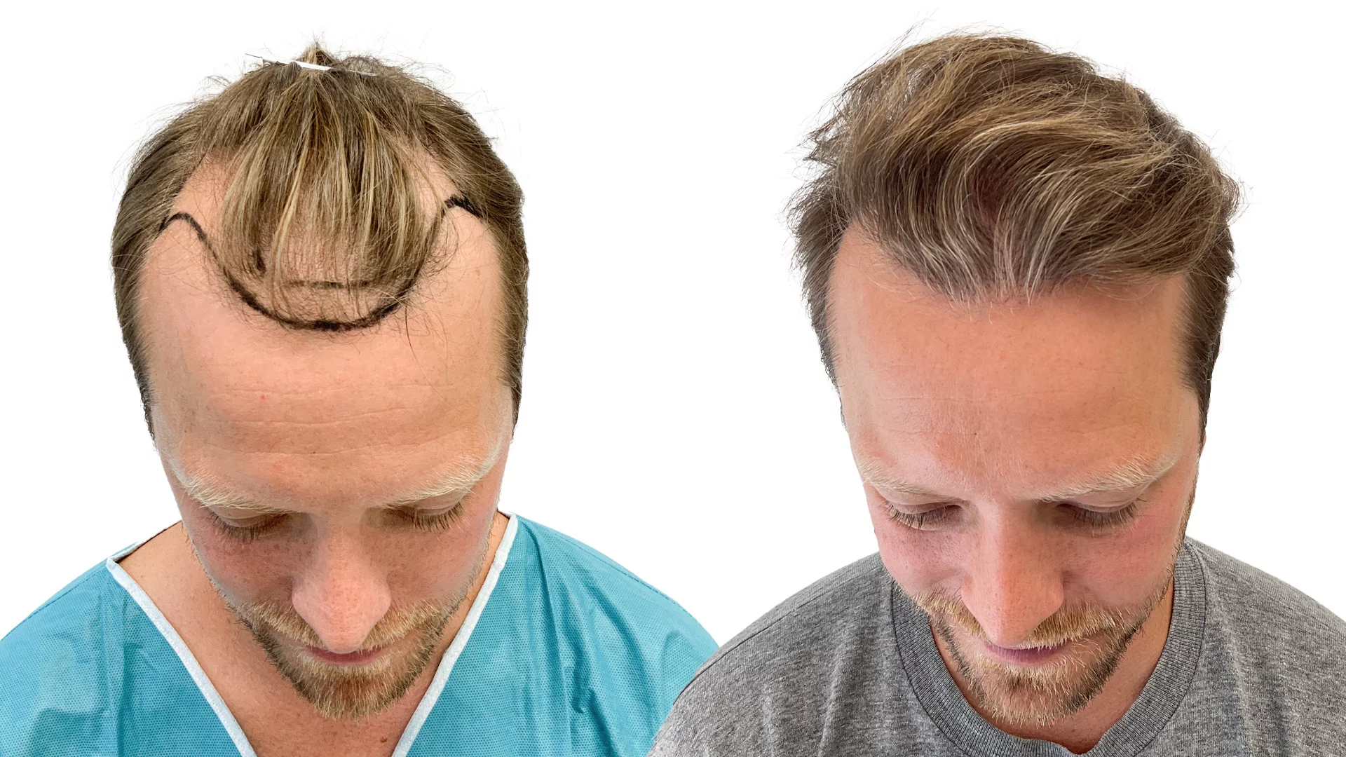 Carl-Johan – før og efter sin hårtransplantation