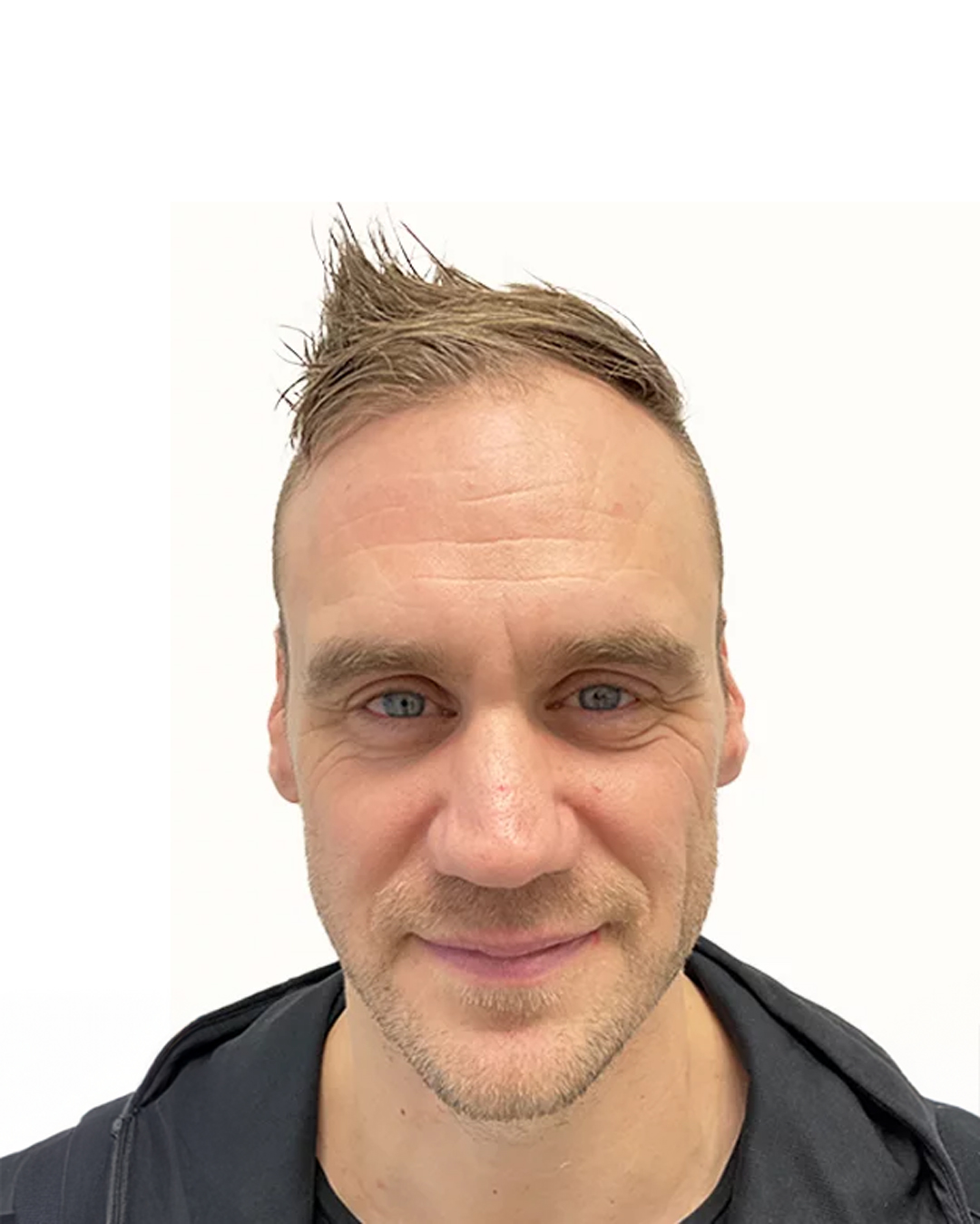 Christer før hårtransplantationen
