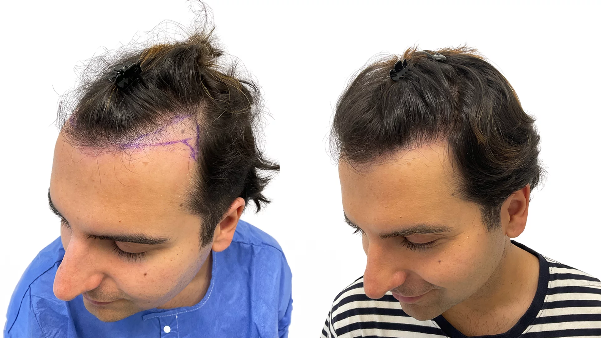 Daniel – før og efter sin hårtransplantation
