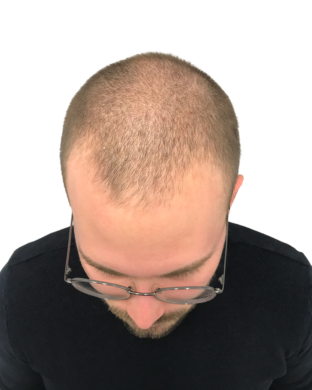 Elias før hårtransplantationen