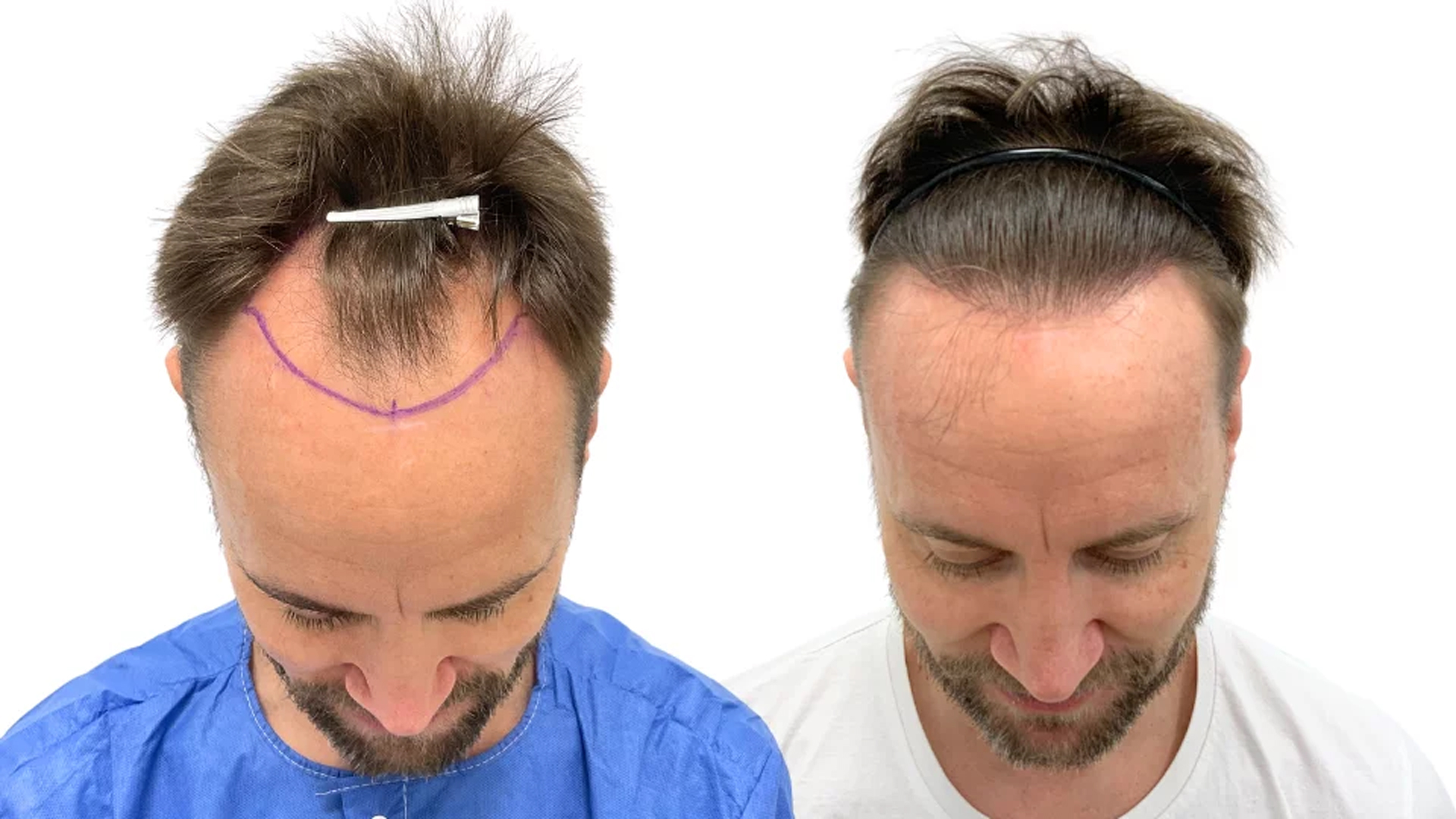 Franz – før og efter sin hårtransplantation