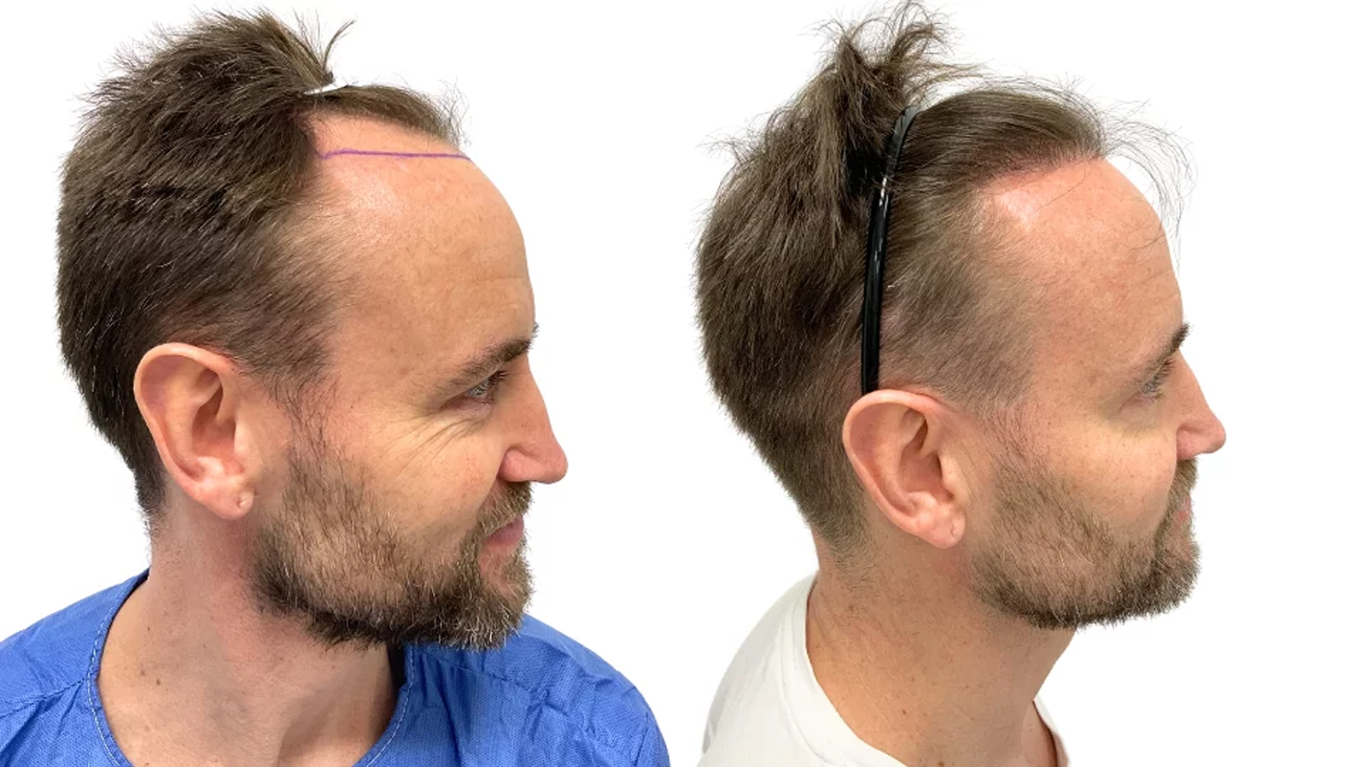 Franz – før og efter sin hårtransplantation