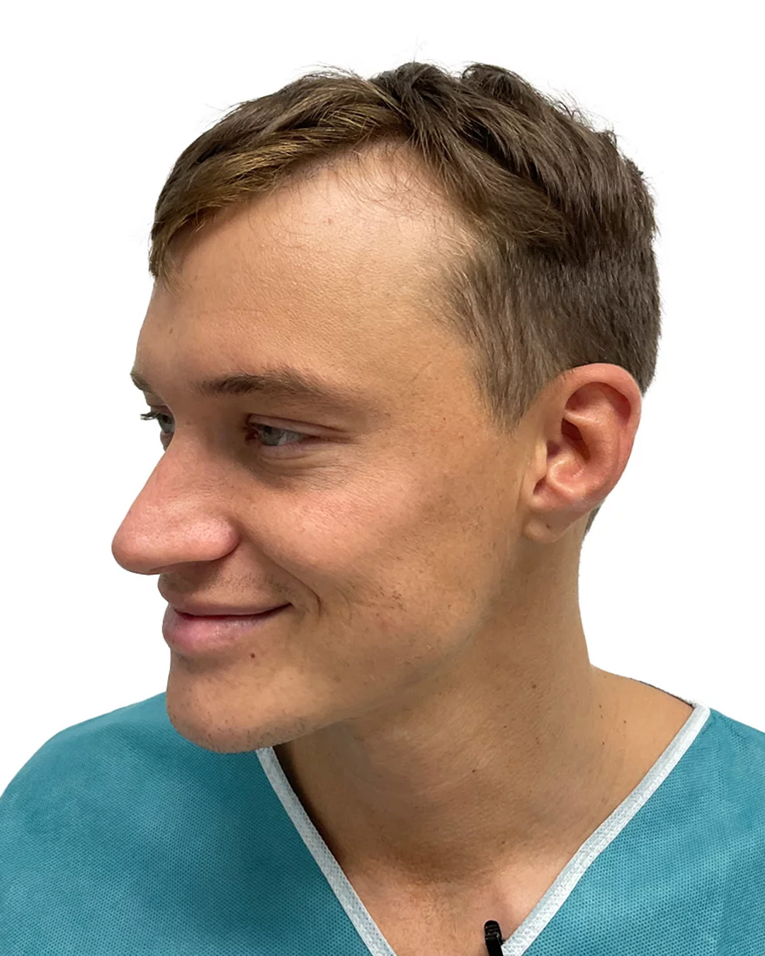 Henrik før hårtransplantationen