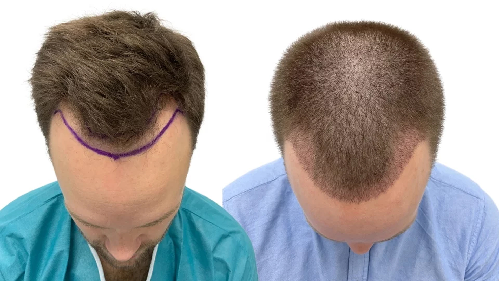 Henrik – før og efter sin hårtransplantation
