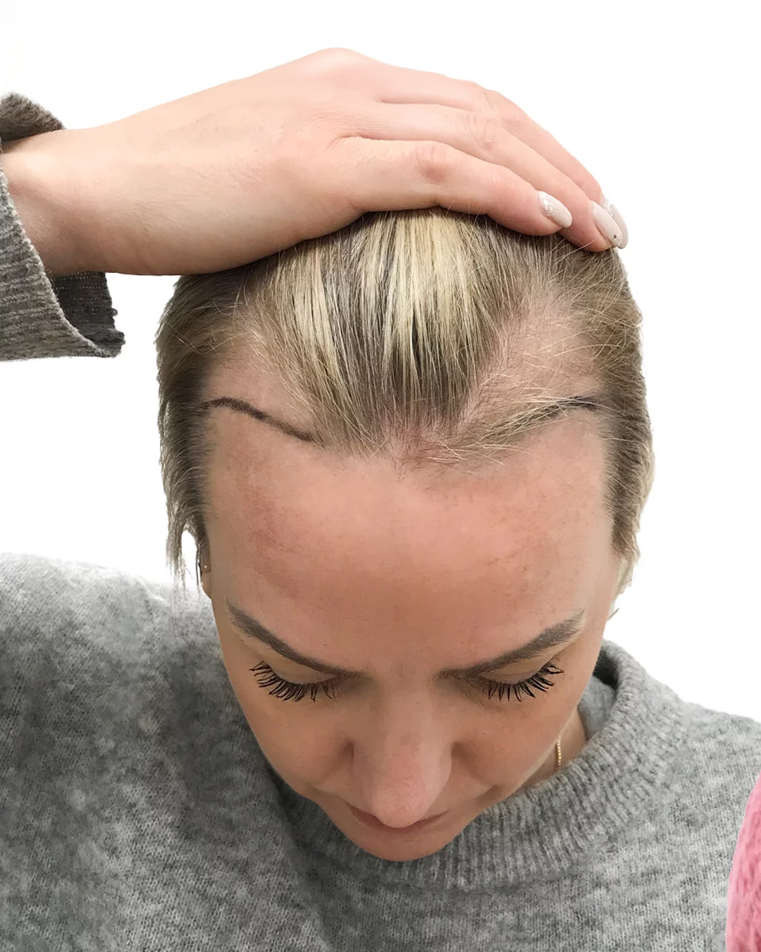 Jennie før hårtransplantationen