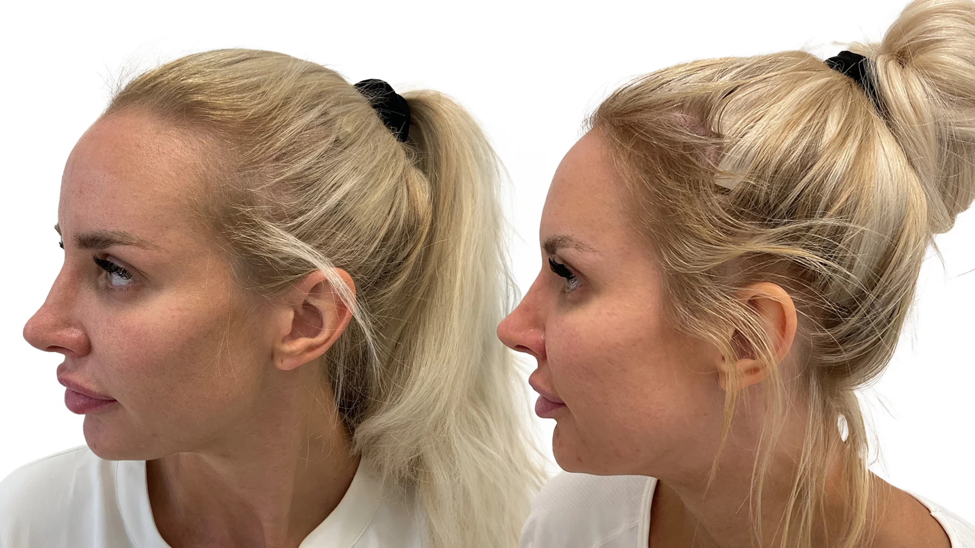 Julia – før og efter sin hårtransplantation