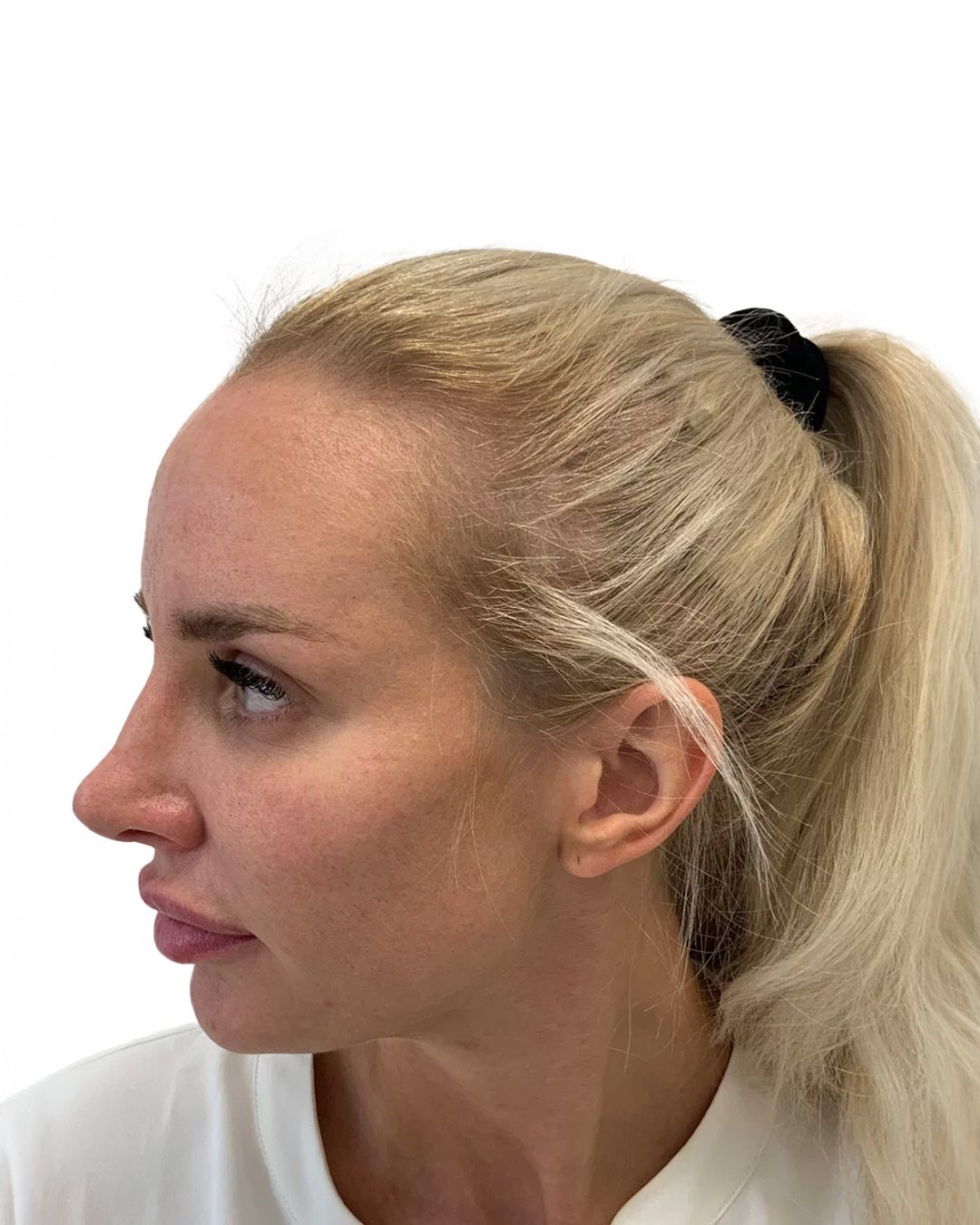 Julia før hårtransplantationen