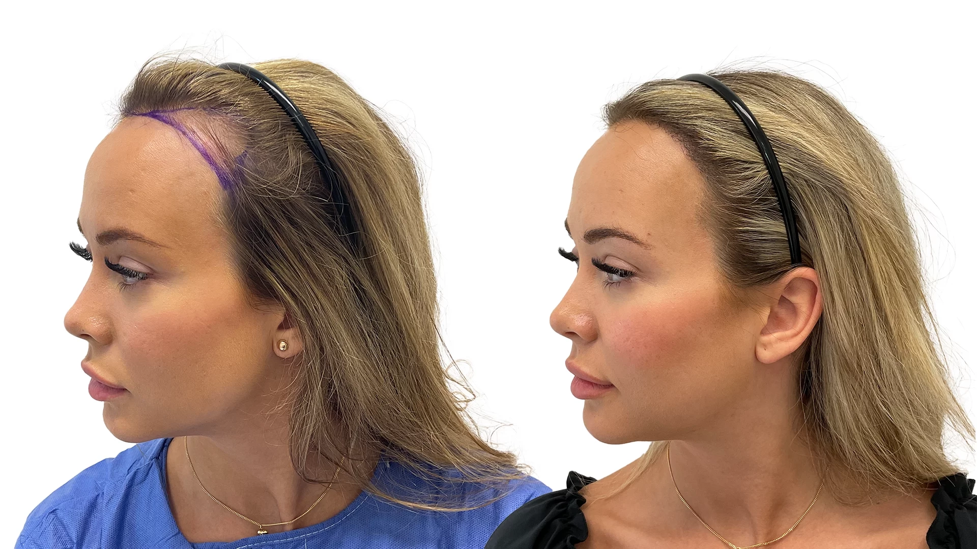 Julia – før og efter sin hårtransplantation