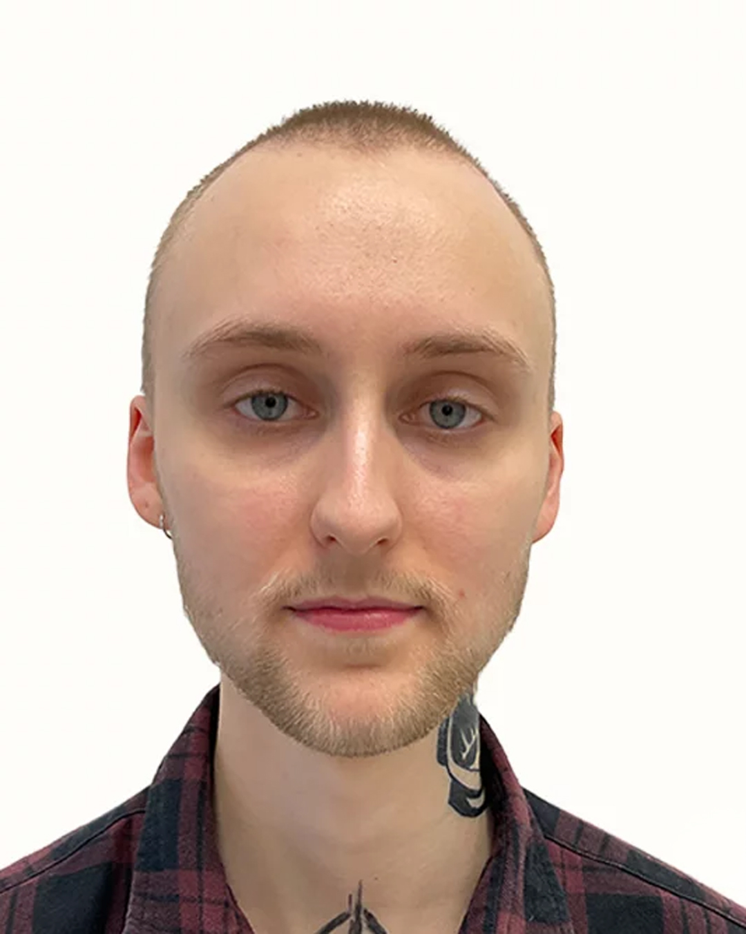 Lucas før skægtransplantationen