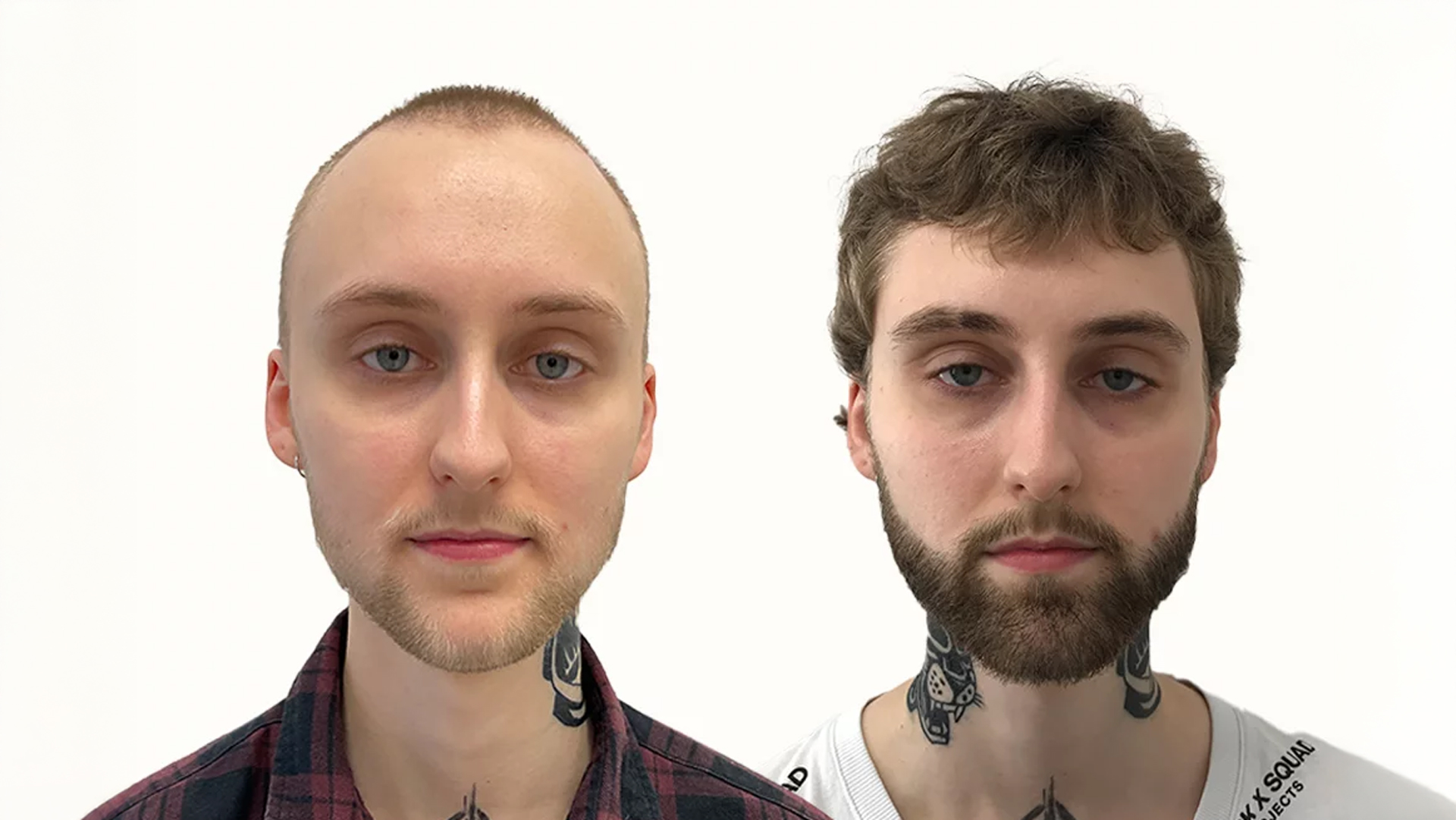 Lucas – før og efter sin skægtransplantation