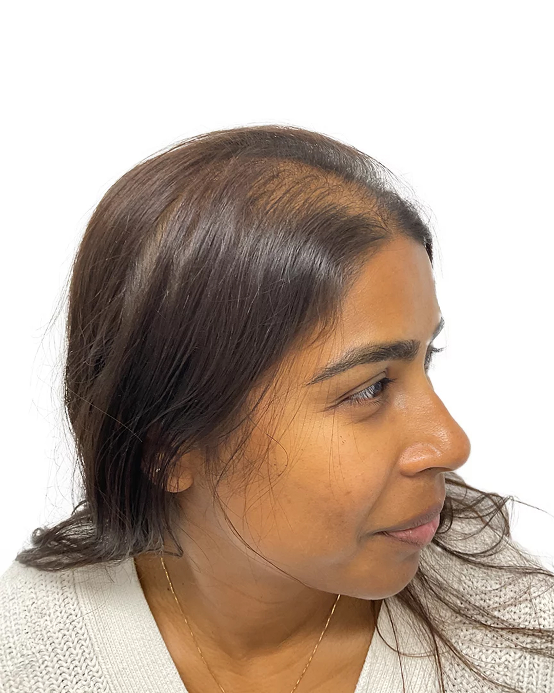 Madelene før hårtransplantationen