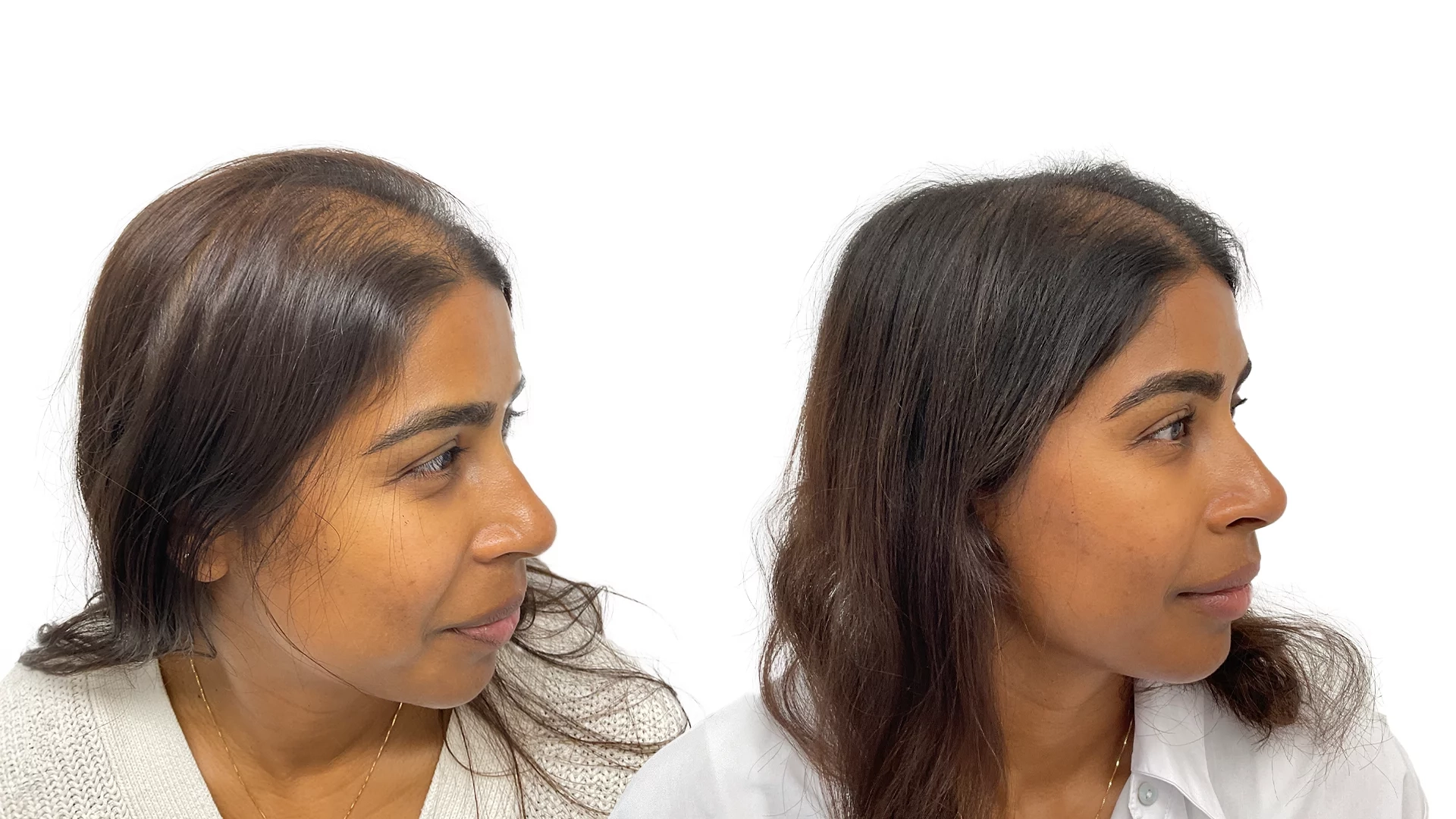 Madelene – før og efter sin hårtransplantation