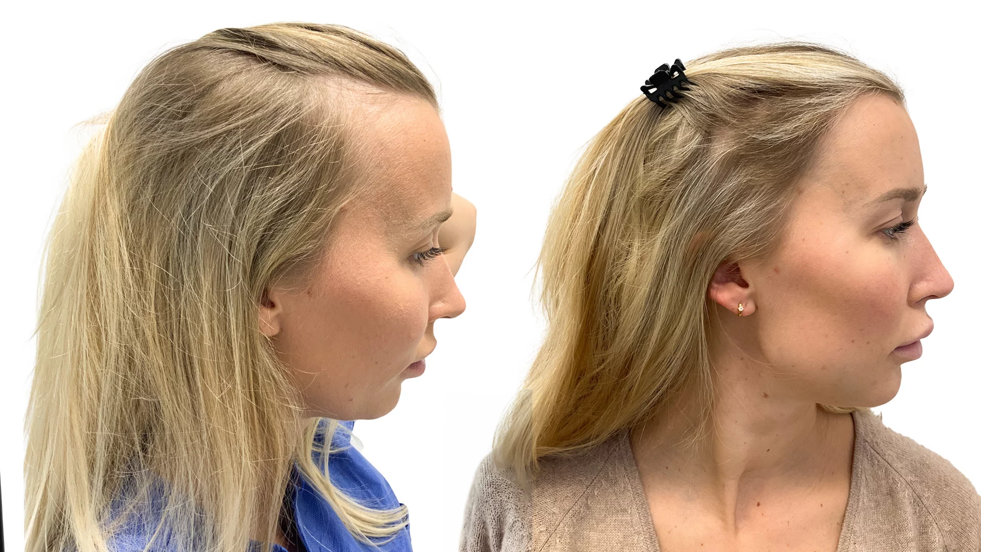 Malin – før og efter sin hårtransplantation