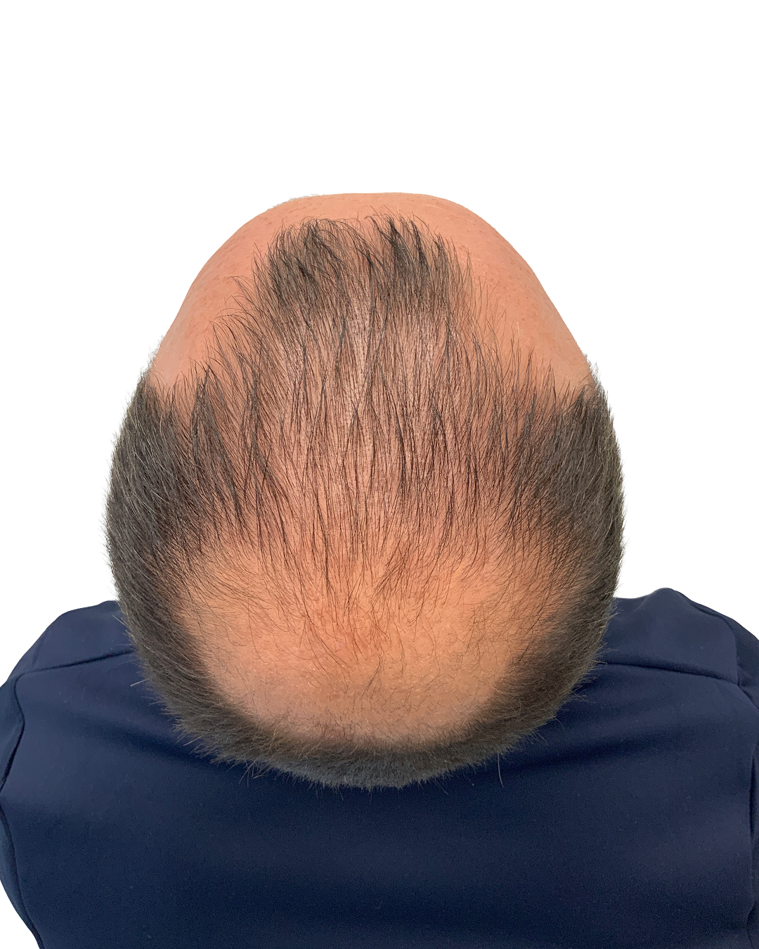 Massimo før hårtransplantationen