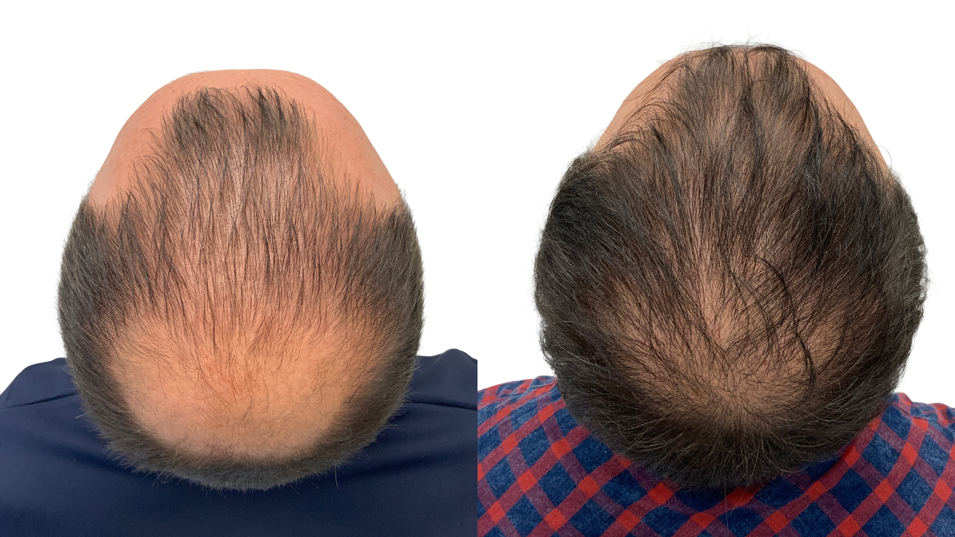 Massimo – før og efter sin hårtransplantation