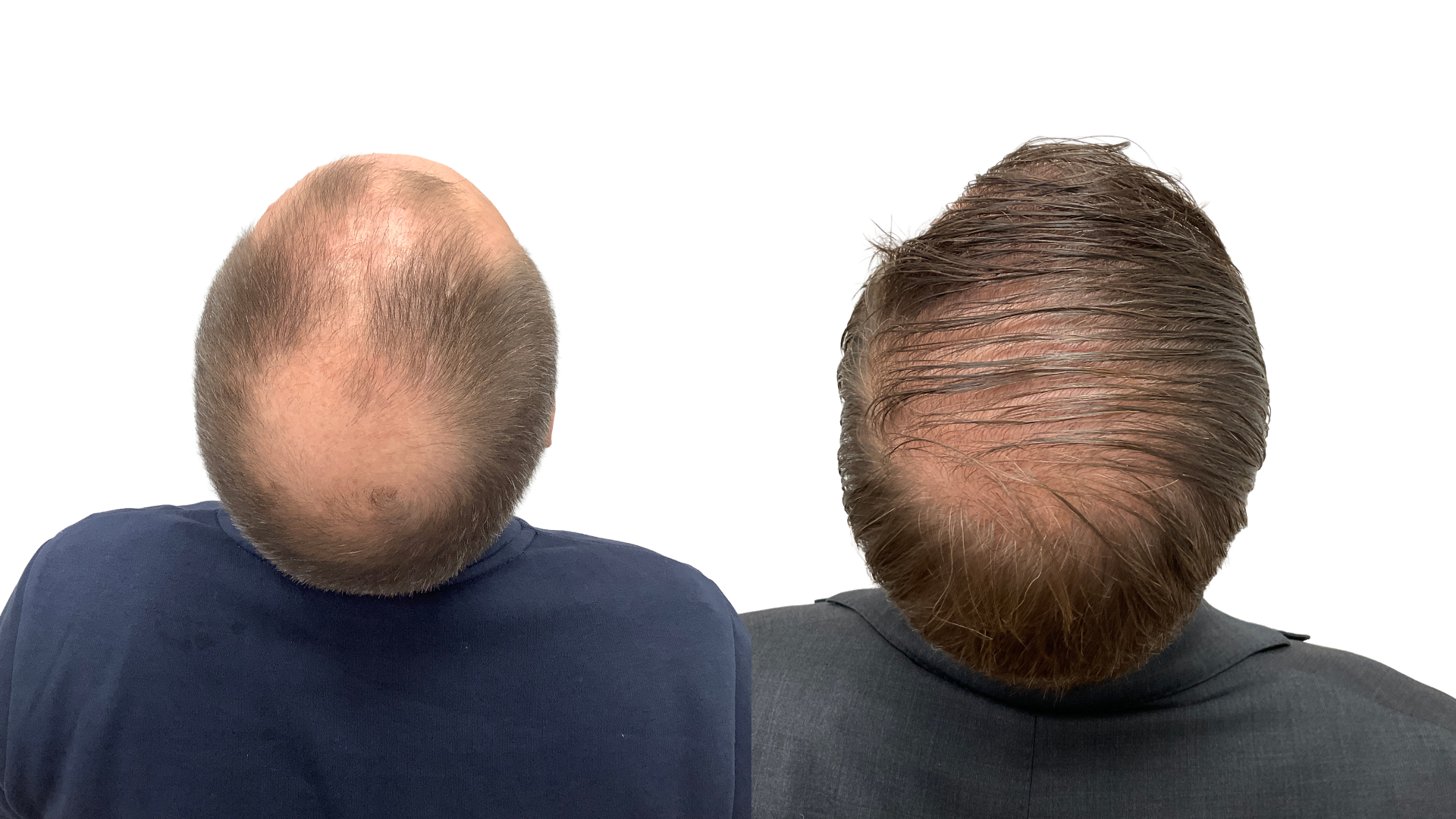 Per – før og efter sin hårtransplantation