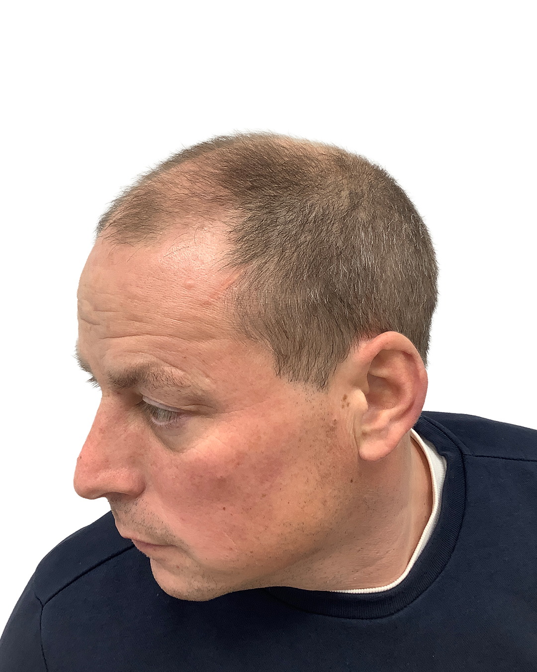 Per før hårtransplantationen