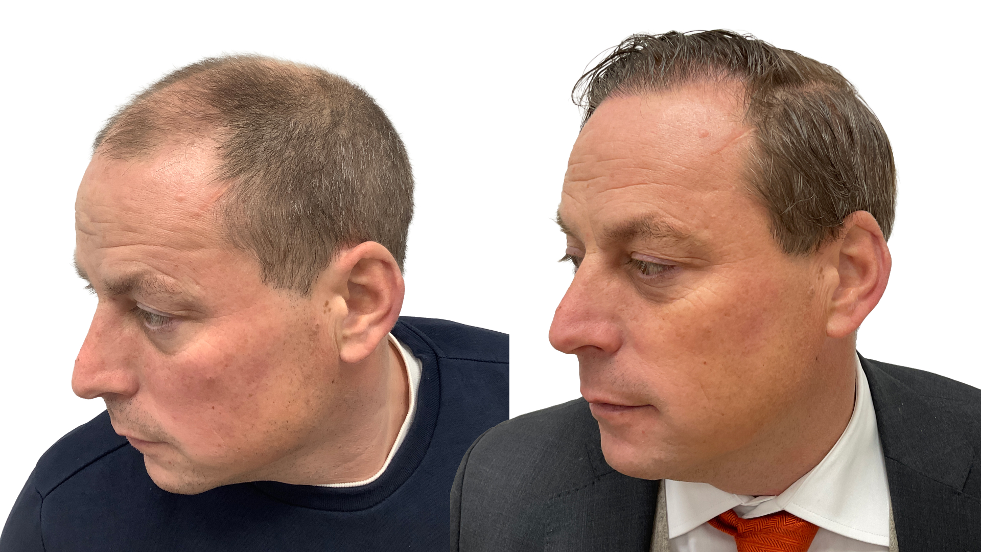 Per – før og efter sin hårtransplantation