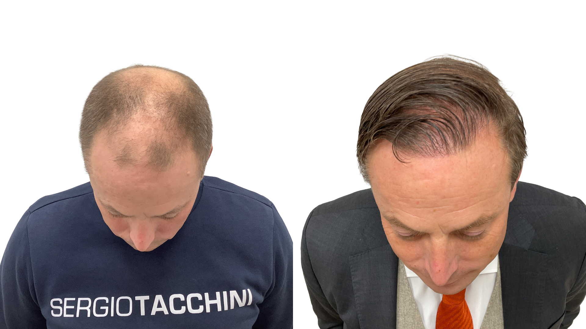 Per – før og efter sin hårtransplantation