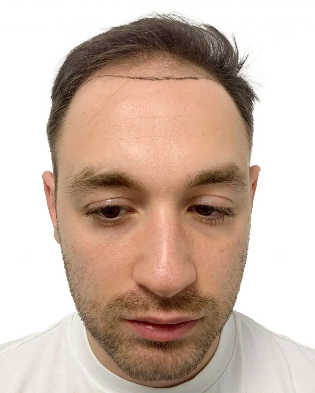 Robert før hårtransplantationen