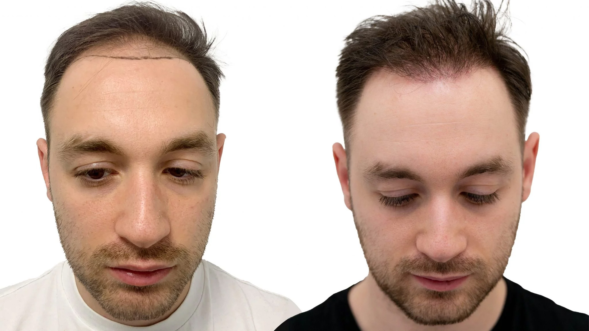 Robert – før og efter sin hårtransplantation