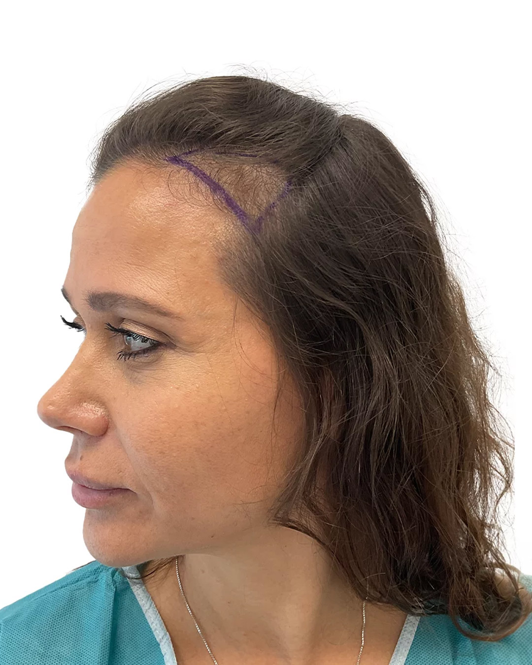 Sandra før hårtransplantationen