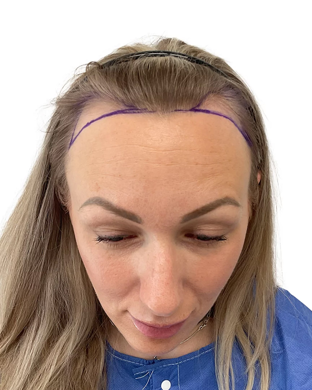 Sandra før hårtransplantationen