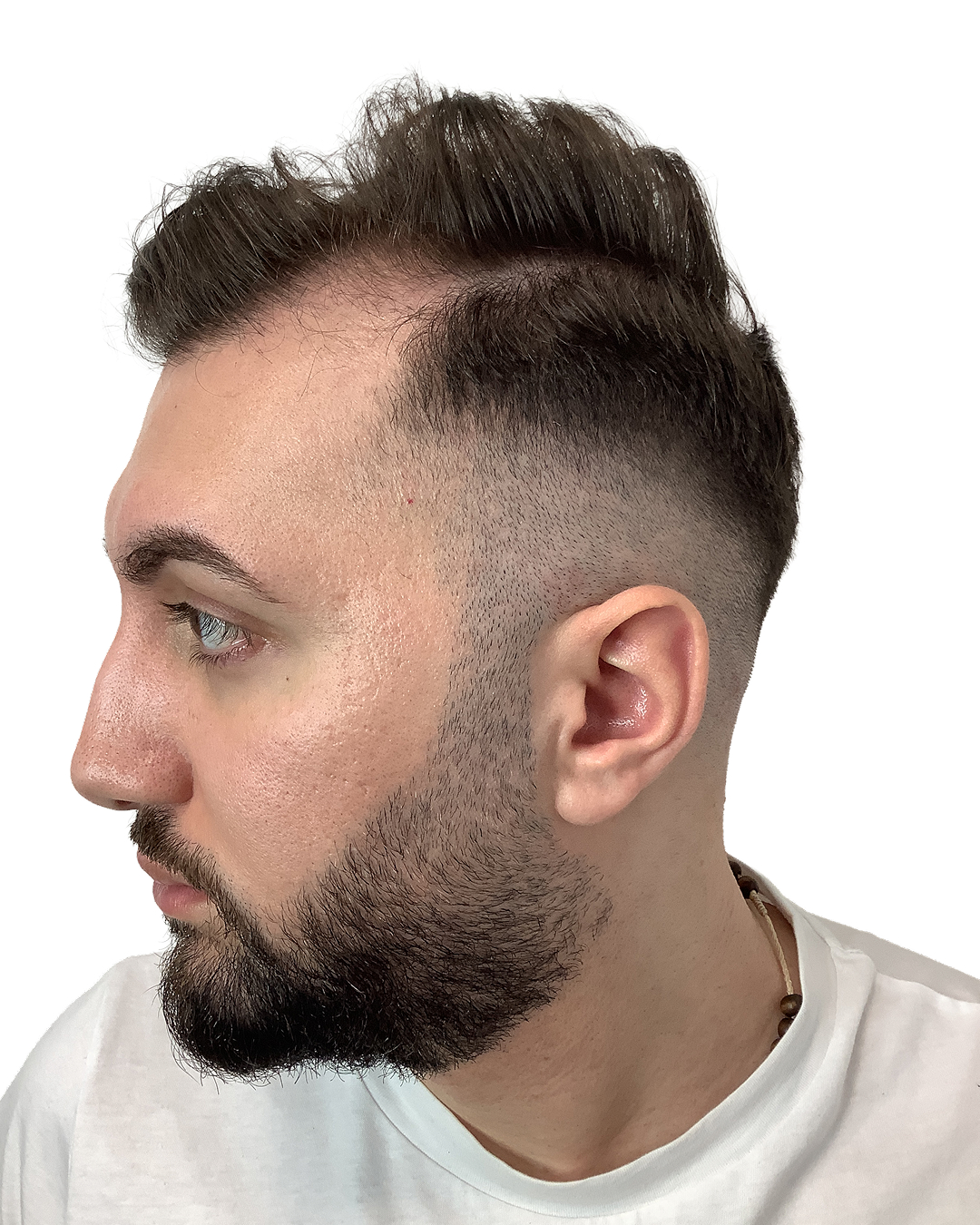 Simon før hårtransplantationen
