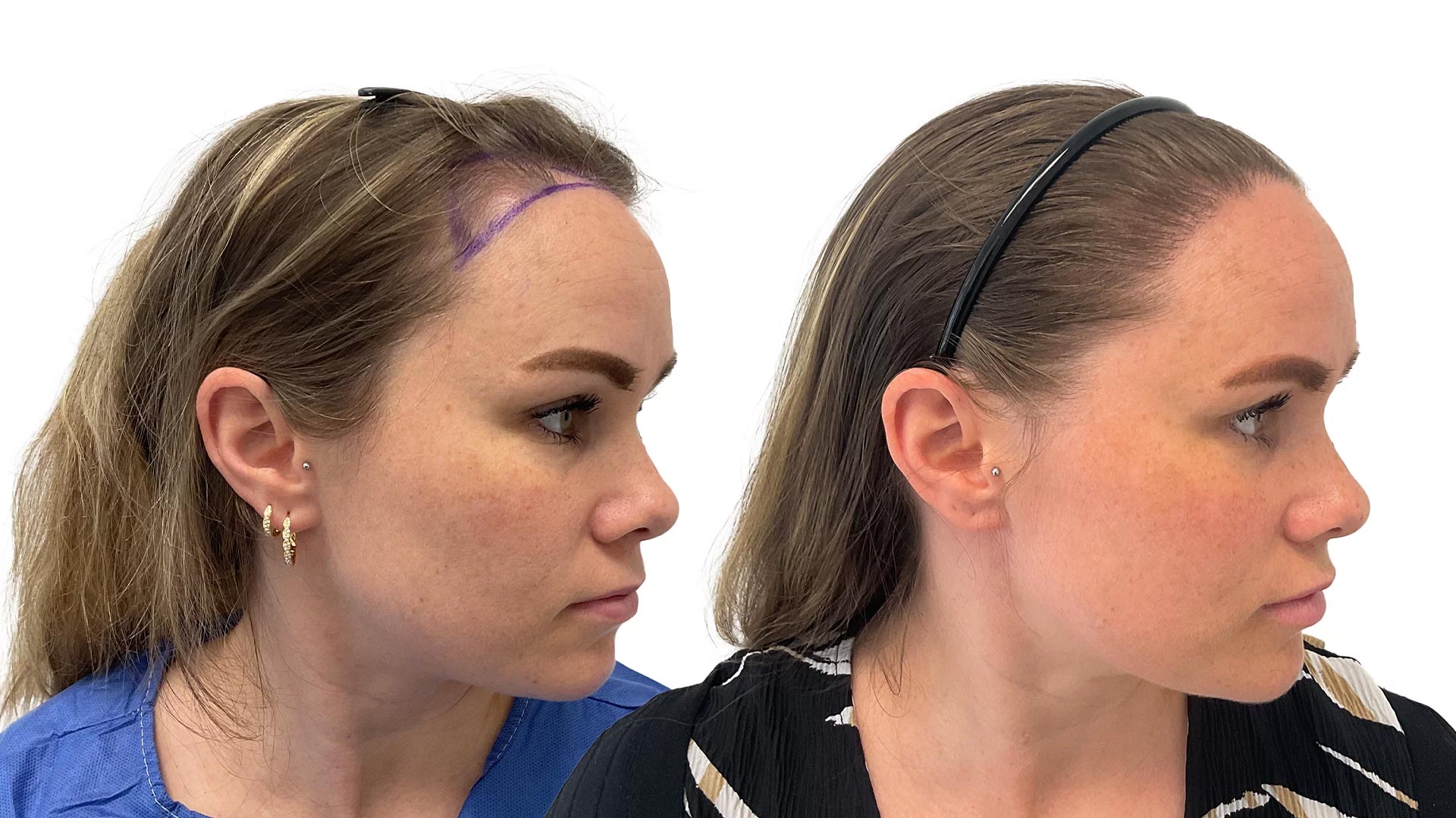 Sofia – før og efter sin hårtransplantation