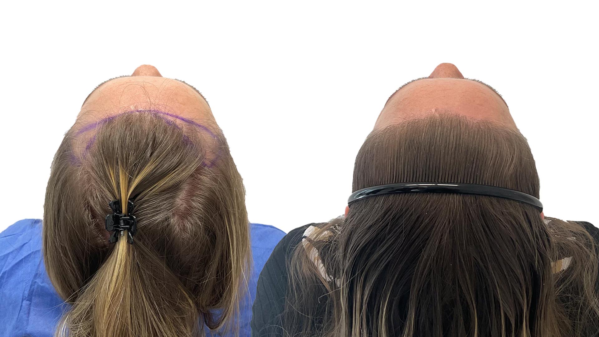 Sofia – før og efter sin hårtransplantation