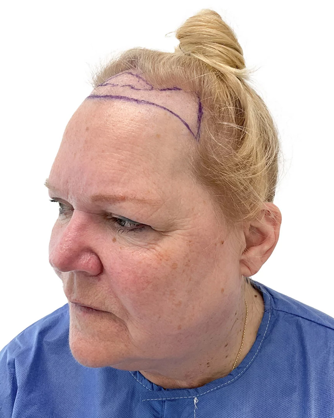 Susanne før hårtransplantationen