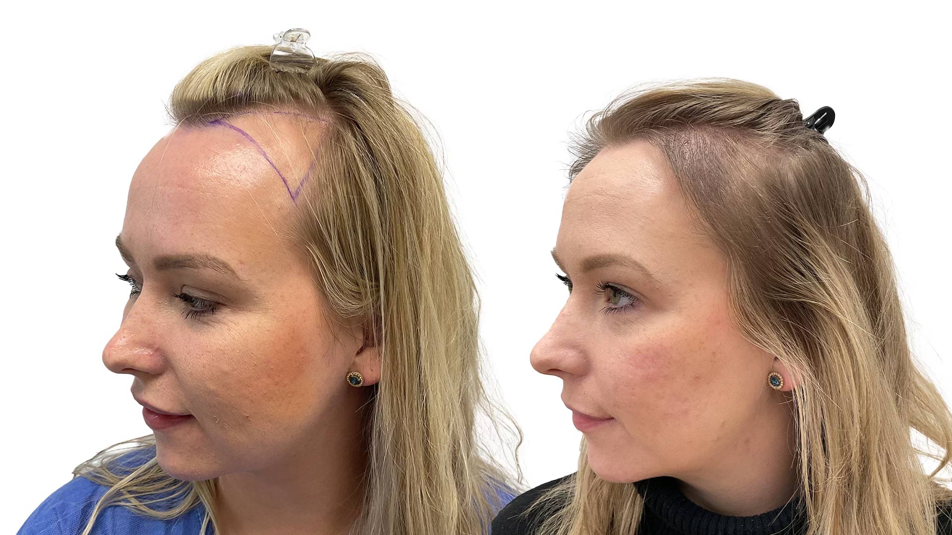 Therese – før og efter sin hårtransplantation
