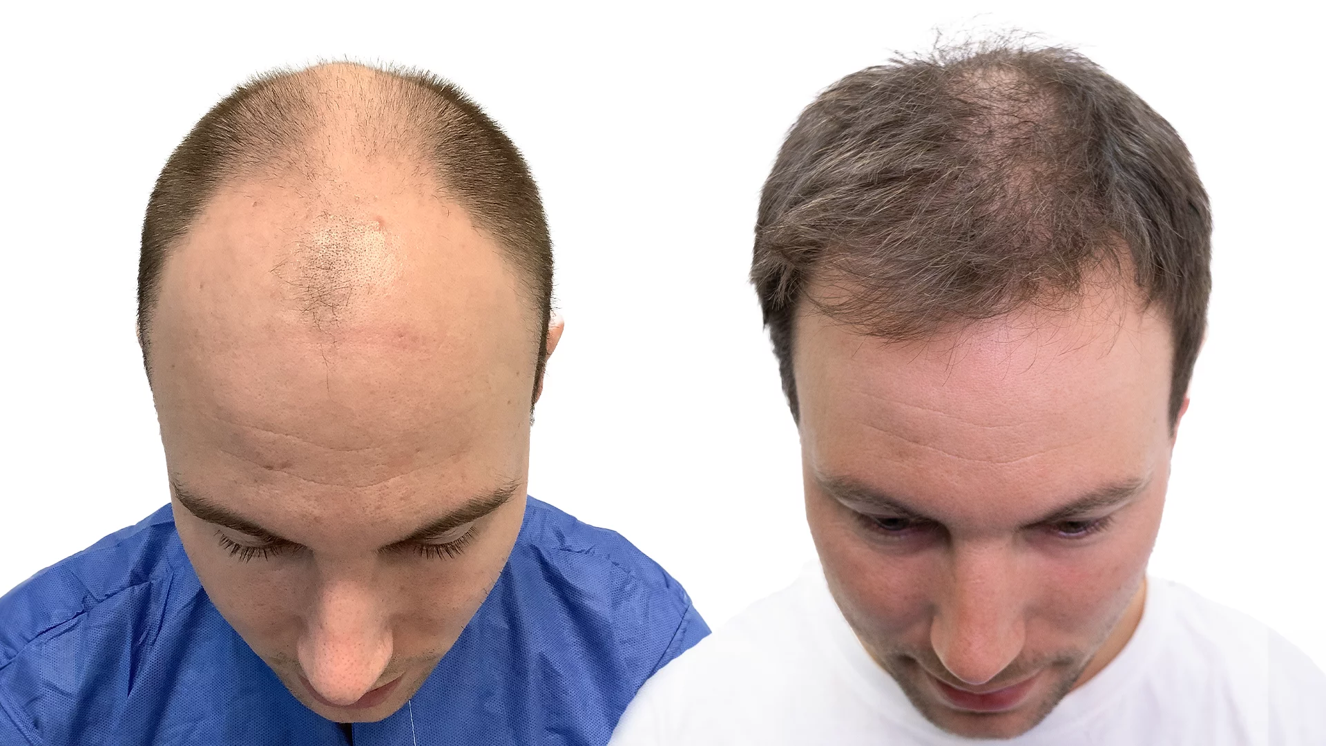 Tobias – før og efter sin hårtransplantation