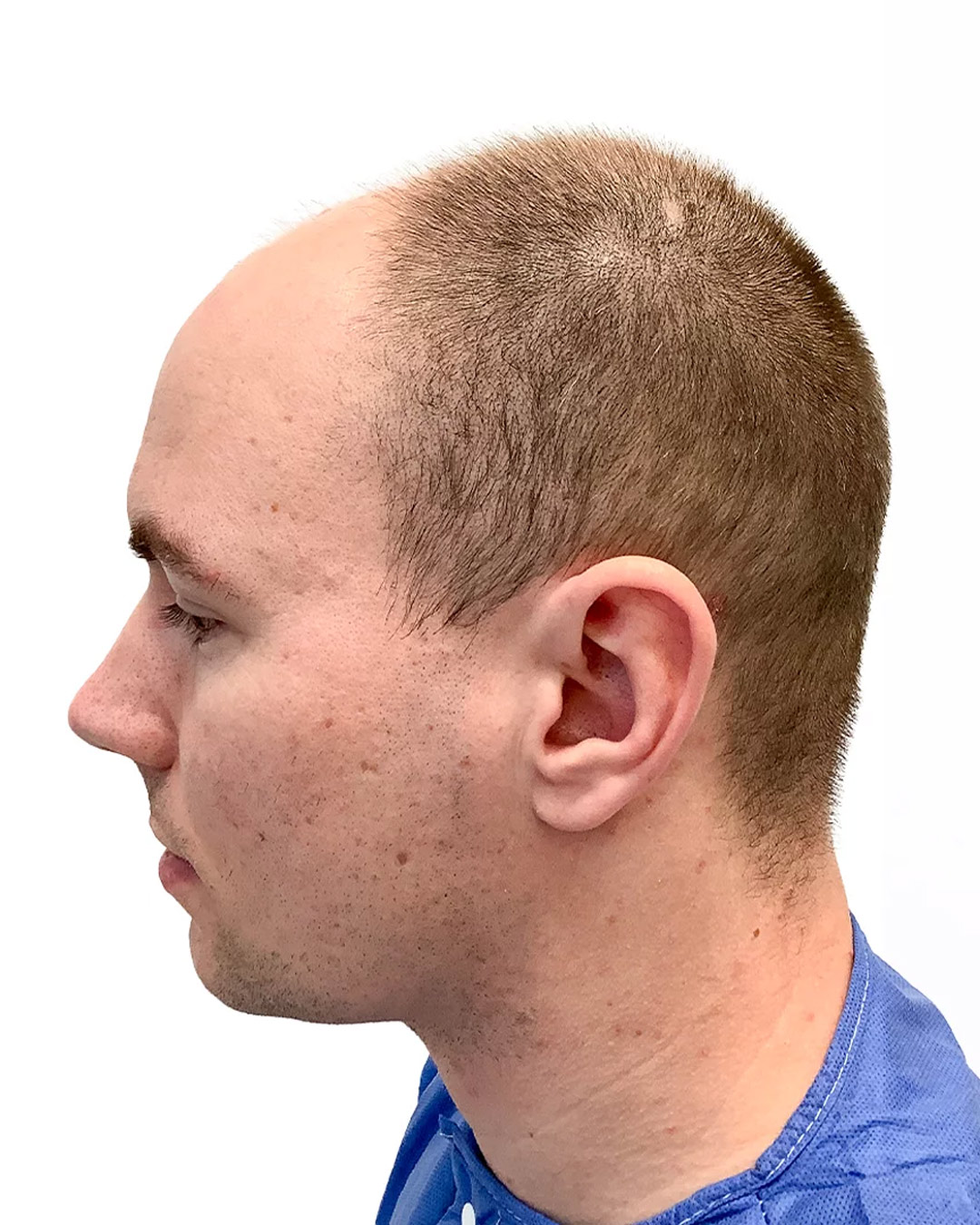 Tobias før hårtransplantationen