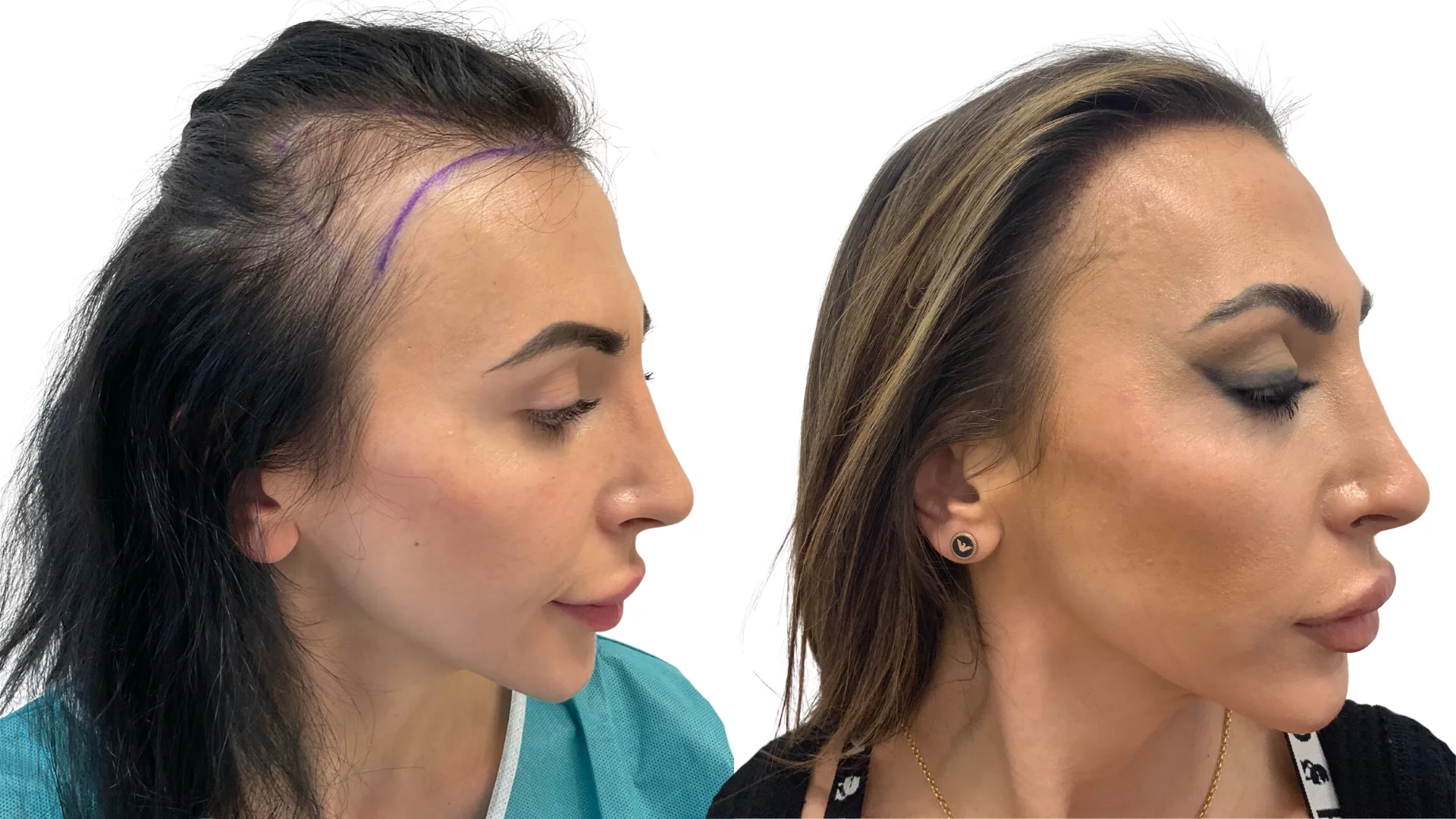 Ines – før og efter sin hårtransplantation