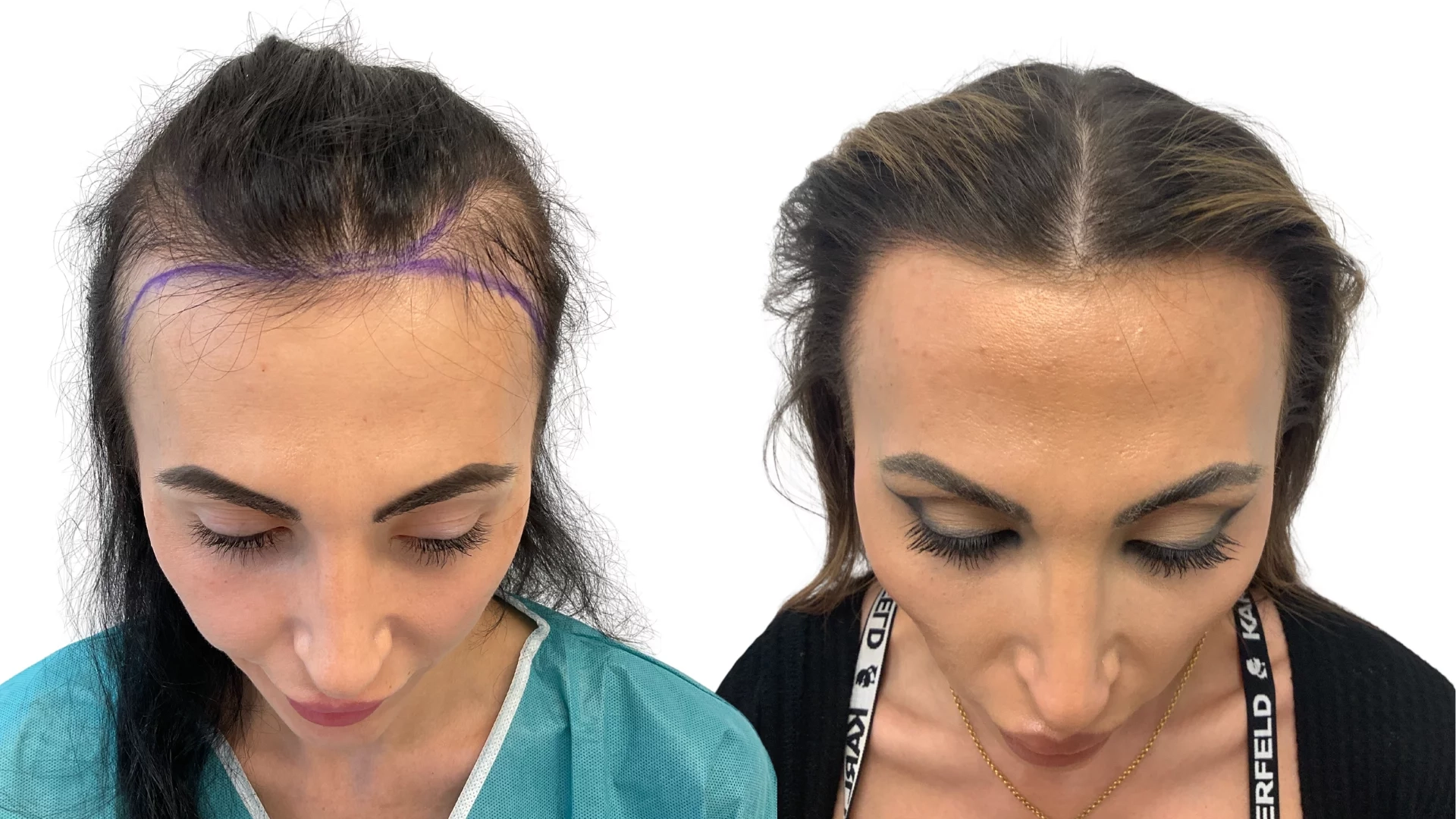 Ines – før og efter sin hårtransplantation