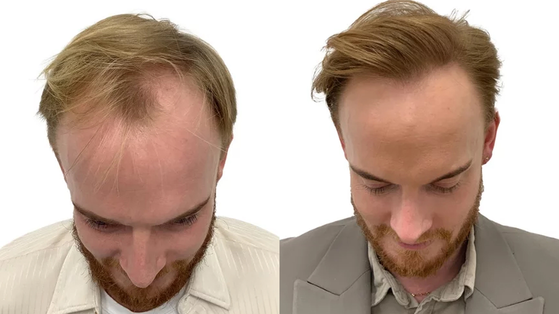Simon – før og efter sin hårtransplantation